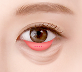 Eye Middle Age Eyelid Lower Blepharoplasty image