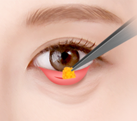 Eye Middle Age Eyelid Lower Blepharoplasty image