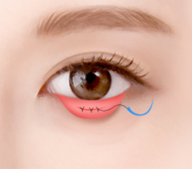 Eye Middle Age Eyelid Lower Blepharoplasty image