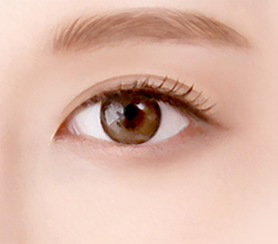 Eye Middle Age Eyelid Lower Blepharoplasty image