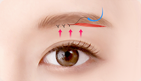 Eye Middle Age Eyelid Natural Adhesion image