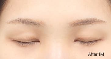 Eye Revision Blepharoplasty Scar Progression image