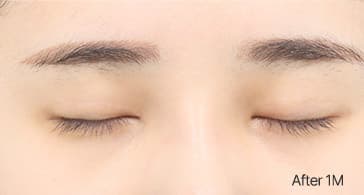 Eye Revision Blepharoplasty Scar Progression image