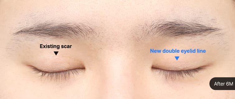 Eye Revision Blepharoplasty Scar Progression image