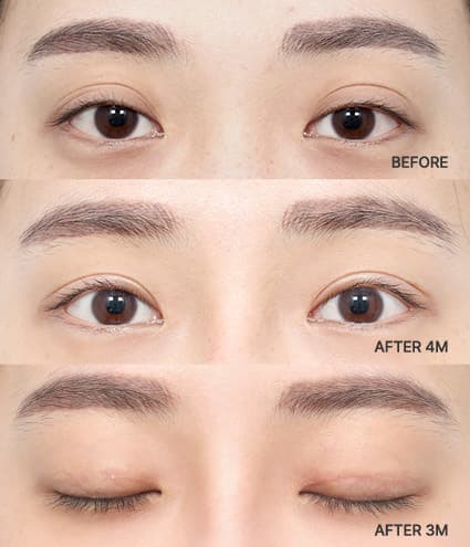Eye Revision Blepharoplasty Solution Solution Card image