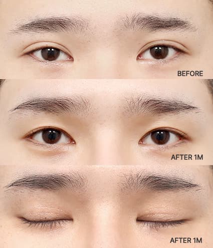 Eye Revision Blepharoplasty Solution Solution Card image
