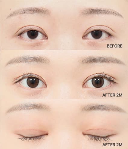 Eye Revision Blepharoplasty Solution Solution Card image