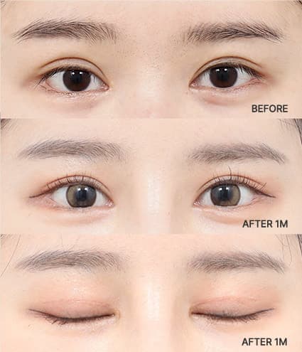 Eye Revision Blepharoplasty Solution Solution Card image