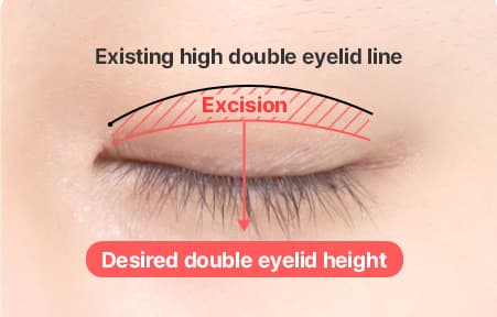 Eye Revision Blepharoplasty Solution Solution Card image