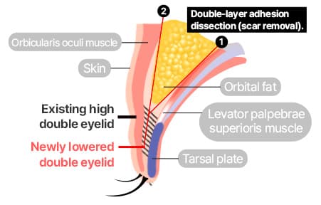 Eye Revision Blepharoplasty Solution Solution Card image