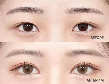 Eye Revision Blepharoplasty Solution Solution Card image