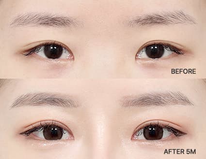 Eye Revision Blepharoplasty Solution Solution Card image