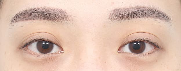 Eye Revision Blepharoplasty Case Swiper image