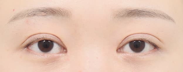 Eye Revision Blepharoplasty Case Swiper image