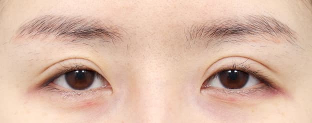 Eye Revision Blepharoplasty Case Swiper image