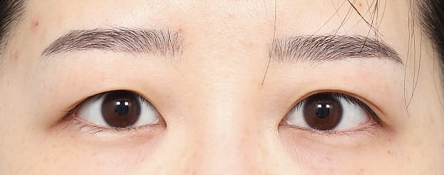 Eye Revision Blepharoplasty Case Swiper image