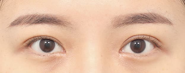 Eye Revision Blepharoplasty Case Swiper image