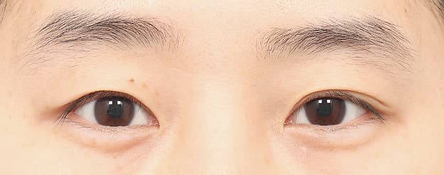 Eye Revision Blepharoplasty Case Swiper image