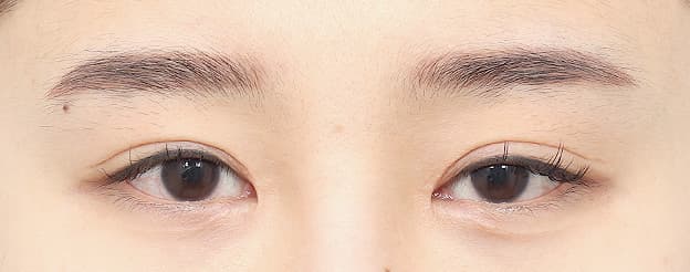 Eye Revision Blepharoplasty Case Swiper image