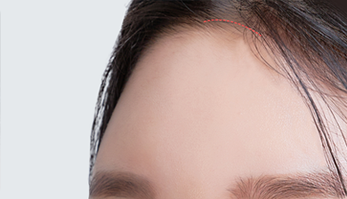 Facial Contouring Facial Implant image