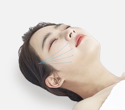 Facial Contouring Soft Tissue Contouring Non Incisional Second image