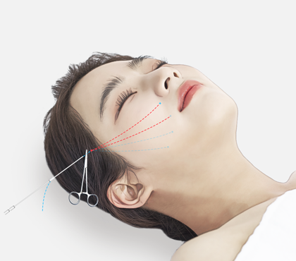 Facial Contouring Soft Tissue Contouring Non Incisional Second image