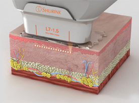 Facial Contouring Soft Tissue Contouring Non Incisional First image