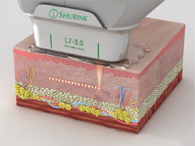 Facial Contouring Soft Tissue Contouring Non Incisional First image
