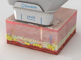 Facial Contouring Soft Tissue Contouring Non Incisional First image