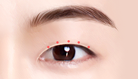 Male Plastic Surgery Male Blepharoplasty image