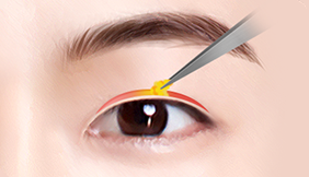 Male Plastic Surgery Male Blepharoplasty image