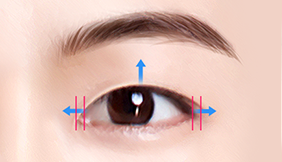 Male Plastic Surgery Male Blepharoplasty image