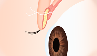 Male Plastic Surgery Male Eye Shape Correction image