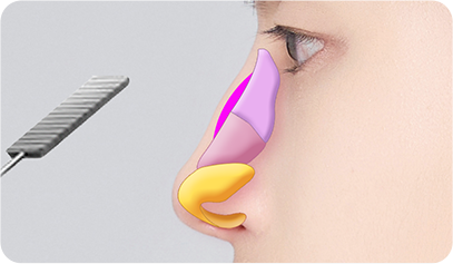 Male Plastic Surgery Male Rhinoplasty image