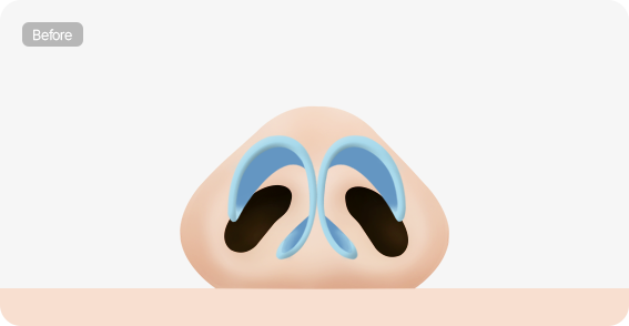 Male Plastic Surgery Male Rhinoplasty image