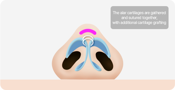 Male Plastic Surgery Male Rhinoplasty image
