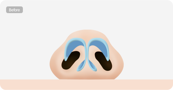 Male Plastic Surgery Male Rhinoplasty image