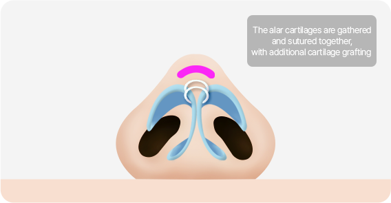 Male Plastic Surgery Male Rhinoplasty image