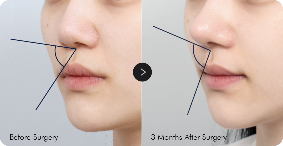 Nose Flat Nose Rhinoplasty Strong Point image