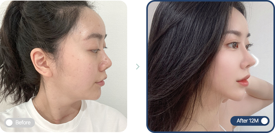 Semi-fancy rhinoplasty know-how for lifting a droopy nasal tip with rib cartilage