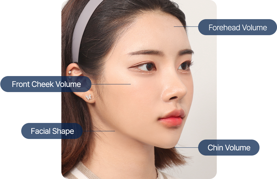 Semi-fancy rhinoplasty know-how for adjusting nose bridge height and starting point