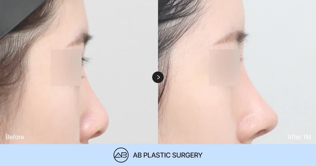 How to Choose the Right Hospital for Revision Rhinoplasty