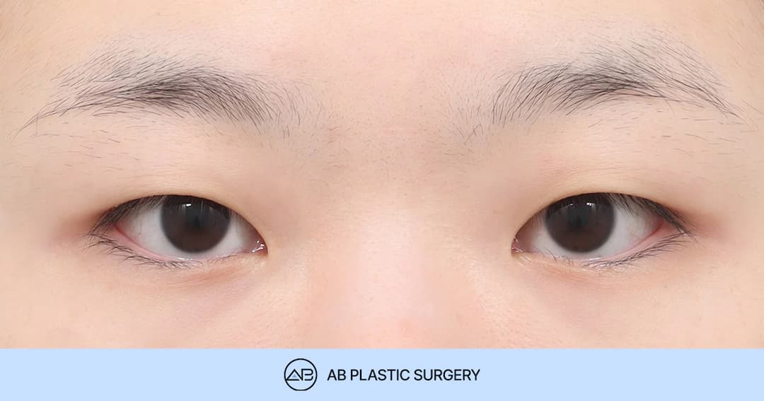 Key Considerations for Double Eyelid Surgery in Patients with Monolids