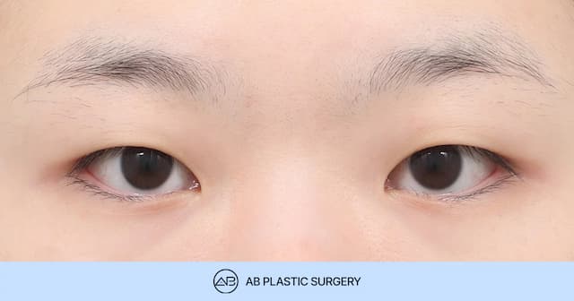 Key Considerations for Double Eyelid Surgery in Patients with Monolids thumbnail