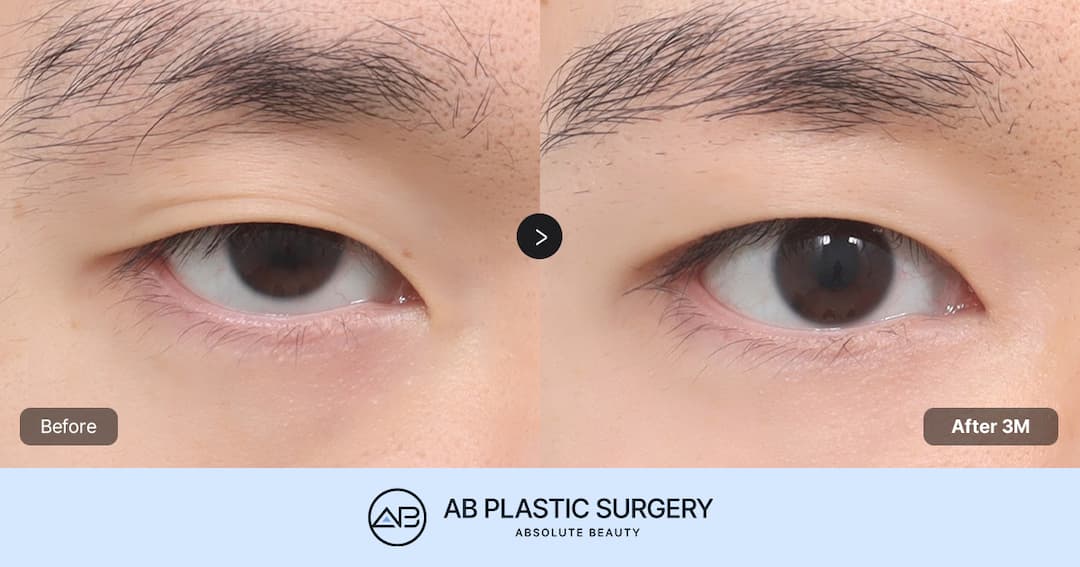 The Key to Masculine Eye Surgery: Creating Naturally Long and Defined Eyes