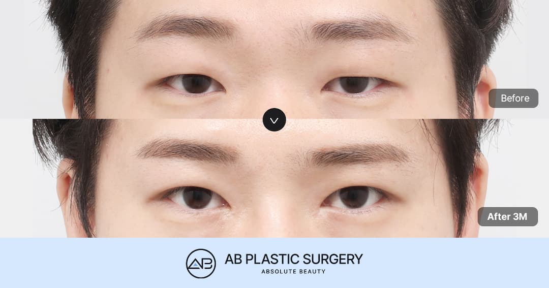 Natural Male Eye Correction Surgery Methods Seen Through Male Ptosis Correction Reviews