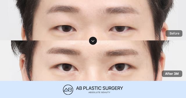 Natural Male Eye Correction Surgery Methods Seen Through Male Ptosis Correction Reviews thumbnail