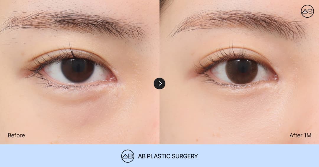 Avoid Regret After Under Eye Fat Removal: The Difference Between Under Eye Fat Removal and Repositioning You Should Check Before Surgery