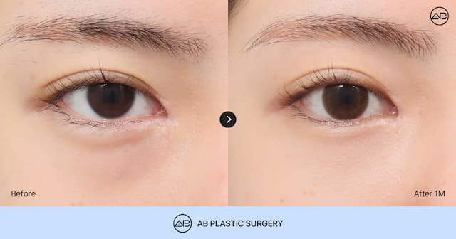 Avoid Regret After Under Eye Fat Removal: The Difference Between Under Eye Fat Removal and Repositioning You Should Check Before Surgery thumbnail
