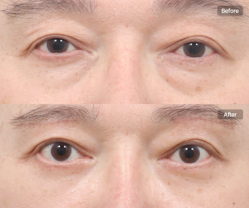 AB Plastic Surgery Elastic and vibrant smooth under-eye visual